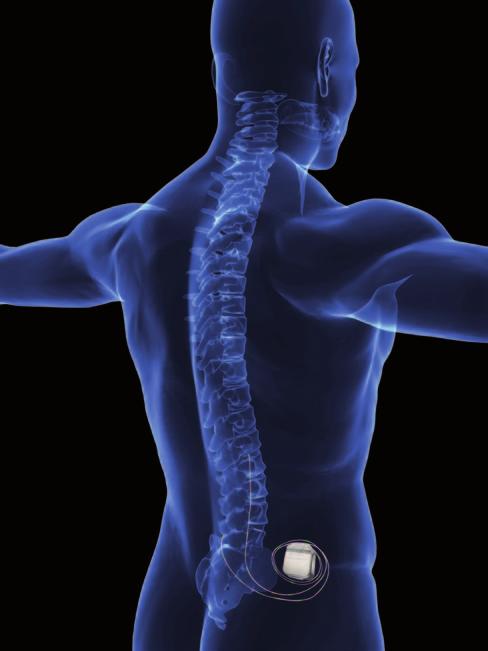 Hoe wordt neurostimulatie gegeven? Zenuwsignalen van over het hele lichaam gaan naar het ruggenmerg en daarna naar de hersenen. De hersenen vertalen de signalen in sensaties zoals pijn.