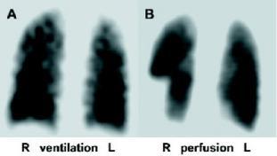 Diagnosis PE Ventilation/Perfusion scan vs CT-PA Radiation dose