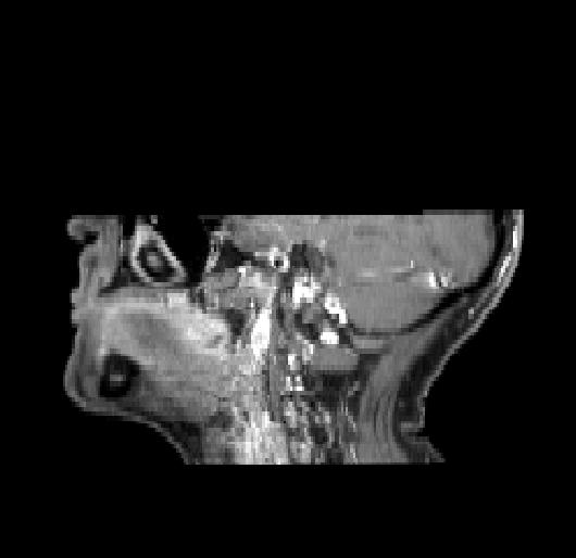 Primaire tumor oesophagus