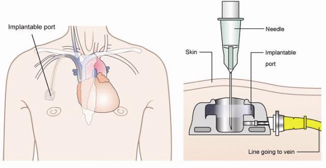 Introductie Gebruik Port-a-cath op de