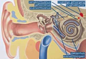 Inleiding Een brughoektumor, ook wel vestibularis-schwannoom of acousticusneurinoom genoemd, is een goedaardig gezwel uitgaande van de omhulling (zenuwschede) van de gehoor- en evenwichtszenuw.