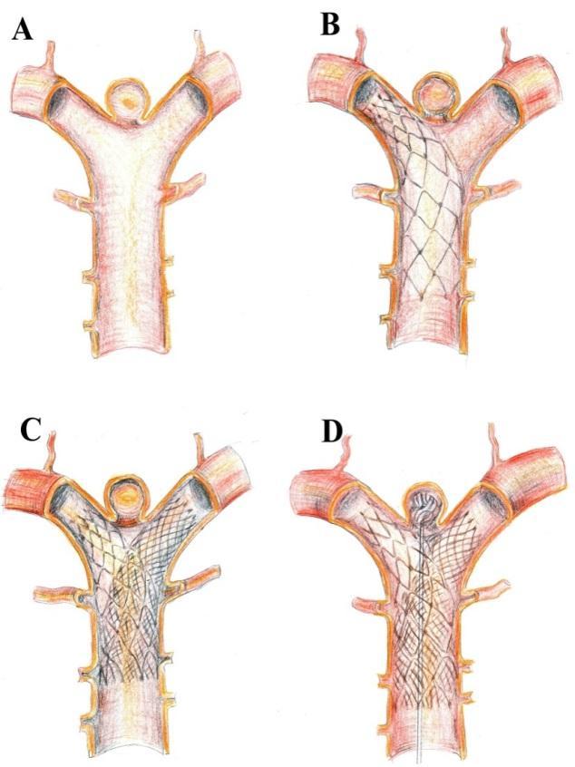 Stent-assisted coiling voorkomt