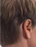 4/7 Het implantaat en abutment in het schedelbot achter het oor De lengte van het implantaat is doorgaans 4 mm Op welke leeftijd is een BCD mogelijk?