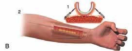 De trachea wordt omwikkeld met het subcutane weefsel en fascia van de voorarm.