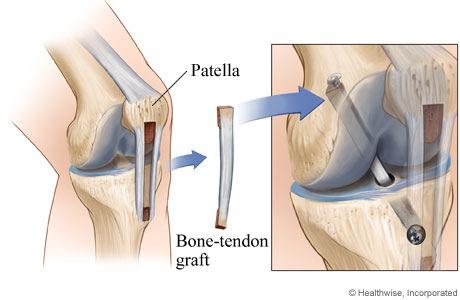 Bij reconstructie gebruikt men een stuk pees. Beide uiteinden van de pees worden geinsereerd in tunnels die geboord zijn in de femur en tibia.