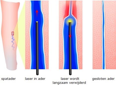 tal prikjes is afhankelijk van de lengte van het te behandelen gebied. Deze prikjes zorgen voor verdoving, koeling van de laserdraad en een goede druk rondom de ader.