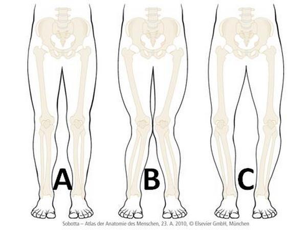Welke stand van de benen ziet u hier afgebeeld?