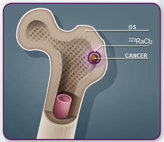 Waarom een behandeling met radium-223? In een vergevorderd stadium van de ziekte zal de prostaatkanker zich mogelijk uitbreiden tot andere delen van uw lichaam.