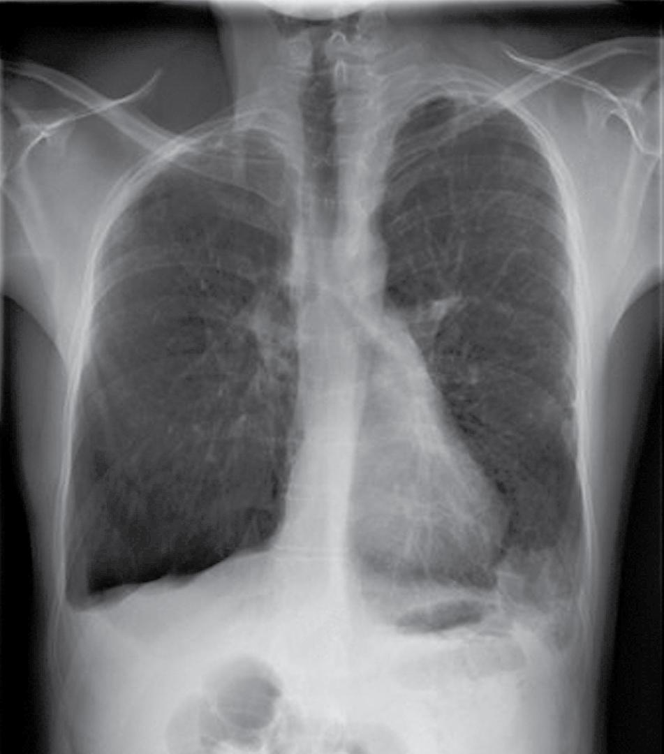 K L I NI SCH E PR AK TI JK een zeer ernstige COPD (stadium IV volgens het Global initiative for obstructive lung disease (GOLD)) en had hij een allergische bronchopulmonale aspergillose ontwikkeld.