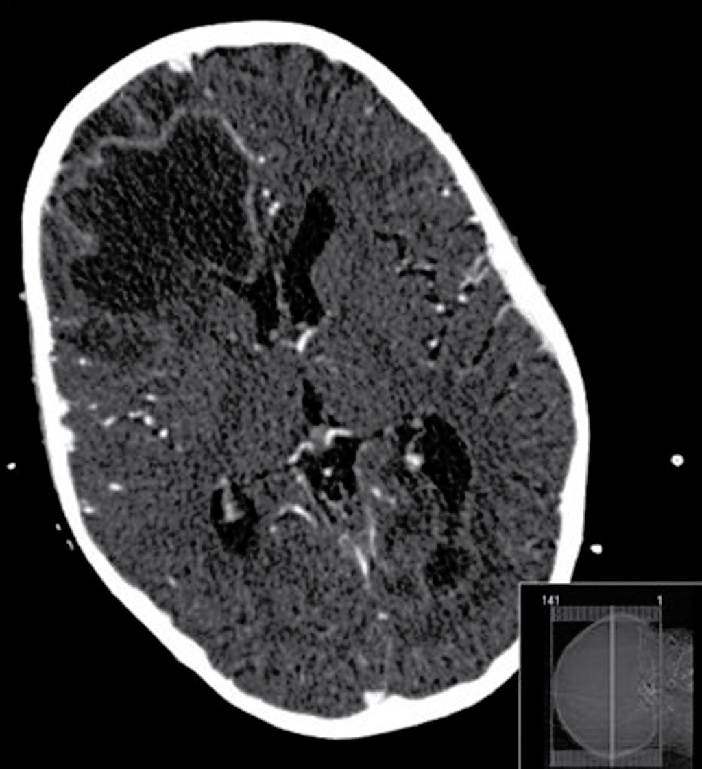 abces ventrikelsysteem KLINISCHE PRAKTIJK FIGUUR 2 CT-scan van het cerebrum van patiënt B, bekend wegens voorloper-b-cel-acute-lymfoblastenleukemie, toont abcesvorming ten gevolge van azoolresistente