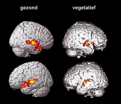 Bij het horen van spraak vertonen de hersenen van bepaalde mensen in een vegetatieve toestand activiteit die vergelijkbaar is met die van de hersenen van gezonde mensen.