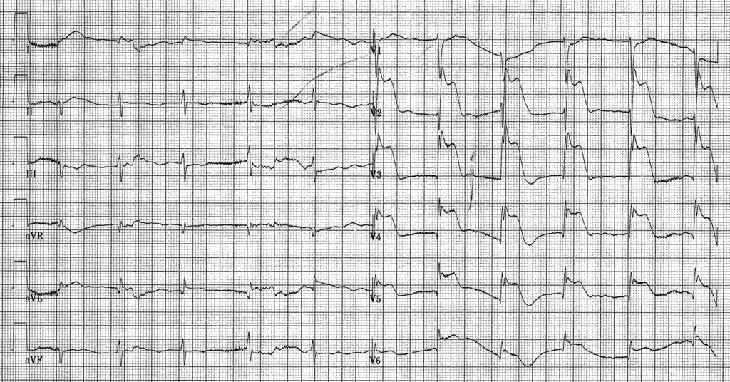 zuurstofsaturatie: 96%; creatininekinase: 573 U/l (< 200); troponine I 0,3 μg/l (< 0,03); lactaat: 9,1 mmol/l (0,5-1,7) en glucose: 14,9 mmol/l (4-6,1).