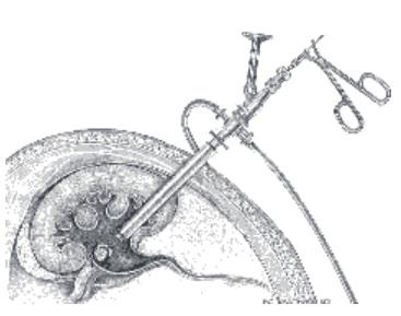 Dit slangetje (genaamd ureterkatheter) komt via de plasbuis naar buiten. De instrumenten worden uit de blaas genomen en de ureterkatheter wordt vastgemaakt aan een blaaskatheter.
