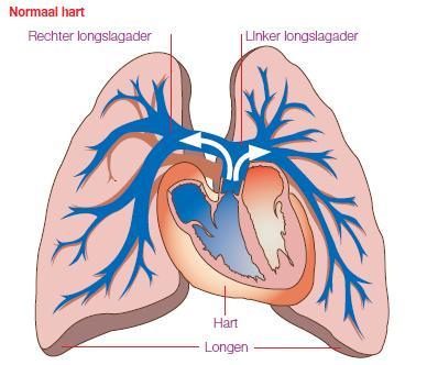 1. Wat is FLOLAN? FLOLAN is een geneesmiddel op voorschrift dat wordt gebruikt voor de behandeling van pulmonale arteriële hypertensie (PAH), een aandoening van de longen en het hart.