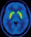 voor deelname gestopt is Misbruik of afhankelijkheid van alcohol of drugs Gebruik van antipsychotica (ooit), ADHD medicatie (of 1 jr. voor deelname gestopt), andere psychofarmaca (of 3 mnd.