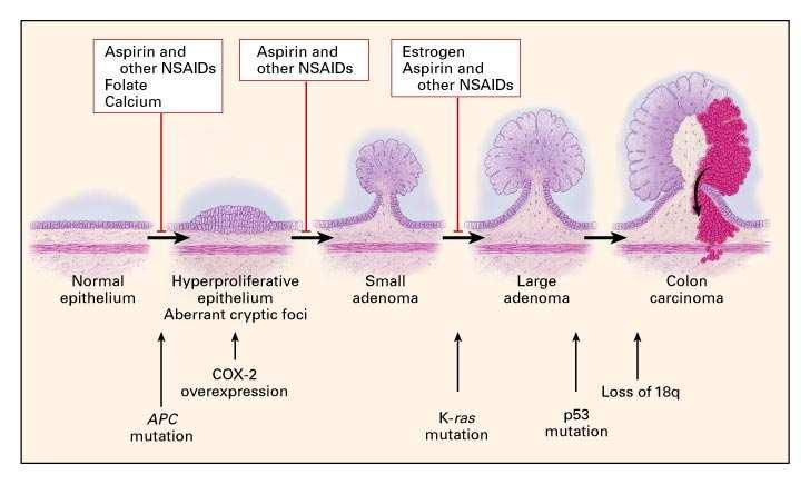 4 Adenoma Carcinoma sequens EVIDENTIE Kans op invasief carcinoom = F (grootte poliep) Zelfde genetische afwijkingen in adenomen