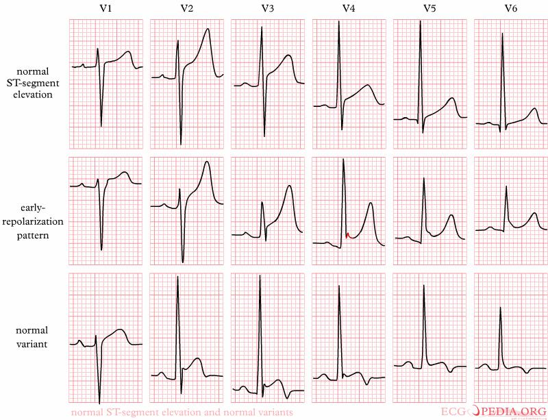 ST elevatie: normaal ST-elevatie: 90% van gezonde mannen heeft ST-elevatie in