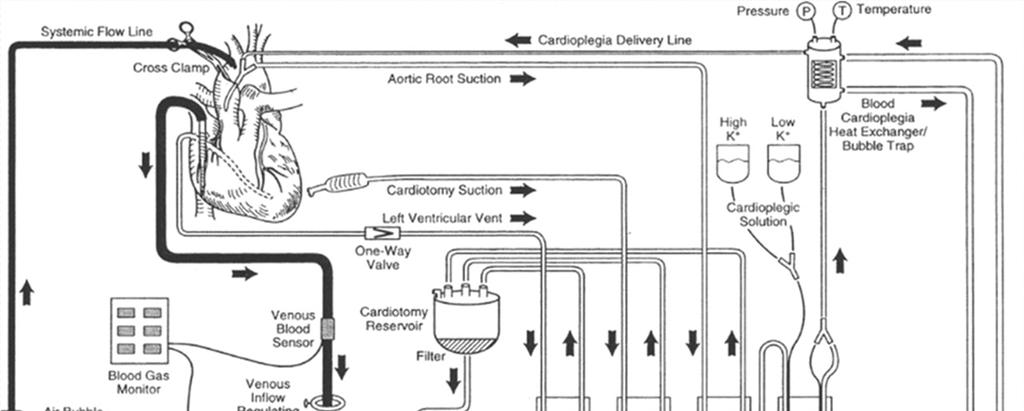 Cardiopulmonale bypass: