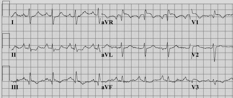 Wat is de diagnose? 1. Sinustachycardie 2. ST + LAHB 3.