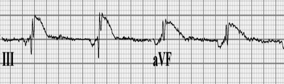 Wat is het ritme? 1. Sinusritme 2. Boezemfibrilleren 3. Boezemflutter 4. Boezemritme 5. SR met 1egr AV blok 6.