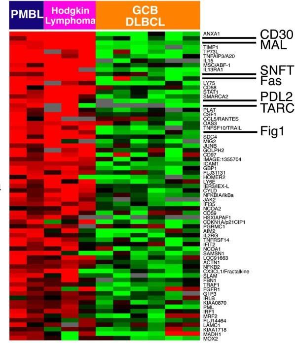 Primair mediastinaal B-cel lymfoom (PMBCL) en IP-DLBCL Gen expressie NGS-shallow sequencing CNA patroon Amplificatie en overexpression van PDL1 en PDL2 Overexpressie van REL