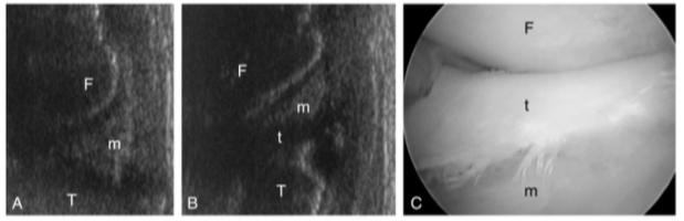 3.4. Chirurgische inspectie Voor het beoordelen van de caudale pool van de meniscus wordt er regelmatig gebruik gemaakt van een laterale of mediale arthrotomie.