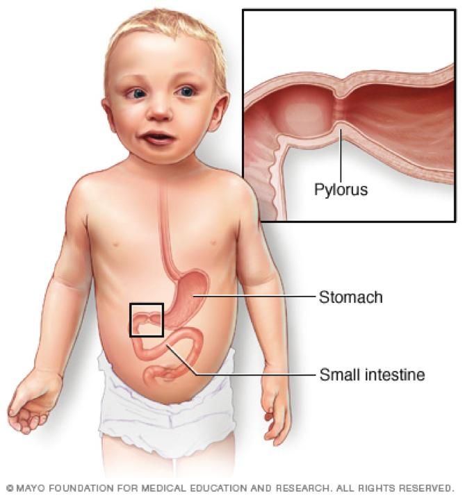 Inleiding Deze folder geeft uitleg over de oorzaak en behandeling van een pylorushypertrofie. Bij uw baby is er een verdenking op een pylorushypertrofie.