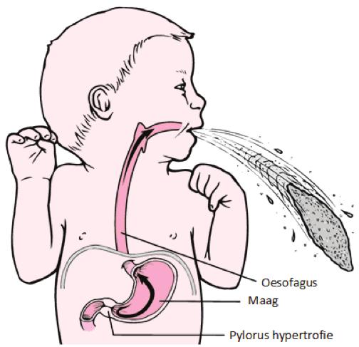 Hoe wordt de diagnose gesteld? Om vast te stellen of het om pylorushypertrofie gaat, onderzoeken wij uw kind op meerdere manieren.