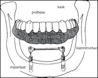 1. WAT IS EEN IMPLANTAAT Een tandheelkundig implantaat kunt u het beste vergelijken met een kunstwortel gemaakt van metaal (titanium), die als een schroef in de kaak wordt geplaatst.