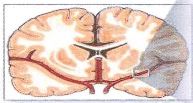ont staat als een bloedvat in de hersenen door een klonter verstopt raakt of als een bloedvat in de hersenen openscheurt. Hierdoor krijgen bepaalde delen van de hersenen onvoldoende bloed en zuurstof.