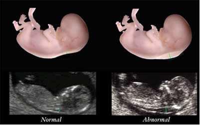 Rol van de prenatale cardioloog bij prenatale diagnose detectie ratio van aangeboren hartafwijkingen behandeling van