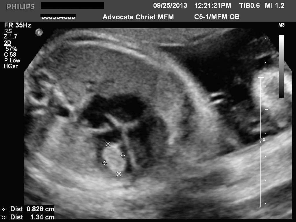 2de trimester (20 24 weken) Groei foetus met Doppler navelstrengvaten Structureel nazicht Anamnese Lichaamsbouw van de