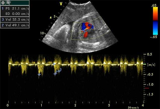congenitale hartafwijkingen bij foetus x4 door hyperglycemie in periconceptionele periode risico op hypertrofe cardiomyopathie door hyperglycemie tijdens de zwangerschap Maternele lupus met positieve