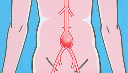 Inleiding Bij u is een verwijding van de grote buikslagader vastgesteld (zie afbeelding 1). Dit wordt ook wel aneurysma van de aorta abdominalis genoemd.