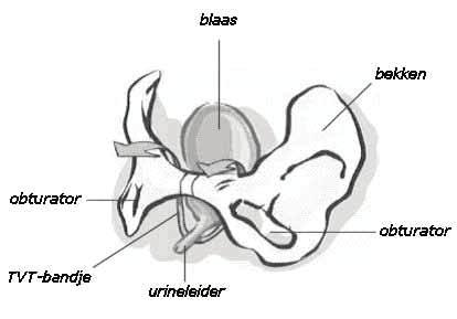 ondersteunt de tape de urinebuis en de spieren van de vagina, waardoor incontinentie wordt voorkomen. De operatie gebeurt onder narcose of met een ruggenprik en duurt ongeveer 20 minuten.