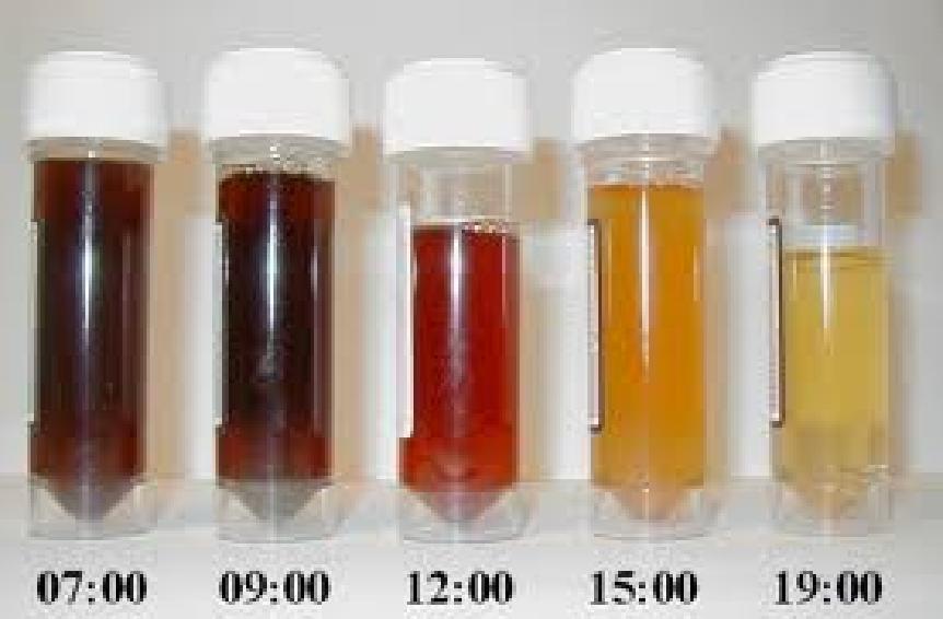 Kliniek van PNH Hemolyse Complement-gemedieerd acute episodes Paroxysmaal nachtelijk hemoglobinurie Ernst ~ Grootte van de kloon Mate van abnormaliteit (type II of