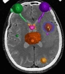 Patient immobilisatie 2. Target Definition 3.