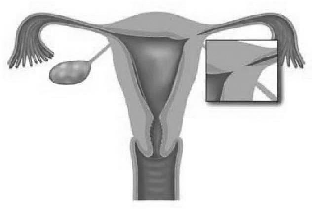 De gynaecoloog kan het spiraal dan via de hysteroscoop meestal gemakkelijk vinden en het met een tangetje verwijderen.