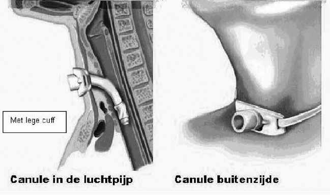 Wat is een tracheostoma? Een tracheostoma wordt via een chirurgische ingreep ingebracht door een arts.