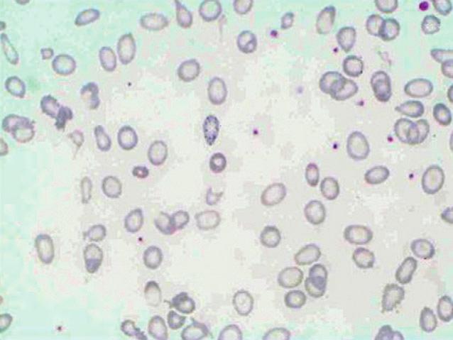 a b figuur 1. Uitstrijkje van perifeer bloed van patiënt A bij binnenkomst. De erytrocyten zijn zeer microcytair en hypochroom.