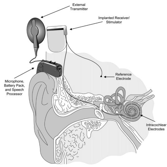INLEIDING 1 Hoofdstuk 1 Inleiding Een cochleair implantaat (CI) is een gehoorprothese voor doven en mensen met zwaar gehoorverlies. Figuur 1.