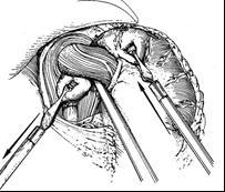 Vervolgens wordt de koepel van de maag als een soort manchet om de overgang van de slokdarm naar de maag heen gehecht.