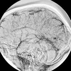 Figuur 1. Cerebrale carotis interna angiografie van de veneuze fase.