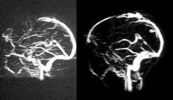 A B Figuur 2. MRI-scan van een veneuze angiografie vóór (A) en na (B) lokale trombolyse. (A) Het voorste deel van de sinus sagittalis superior is niet gevuld.