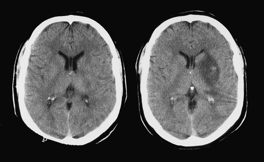 a b infarct nucleus lentiformis bloeding figuur 3. CT-scans van de hersenen van patiënt L in het acute stadium (a) 65 min na het ontstaan van de verschijnselen, (b) na 24 uur.