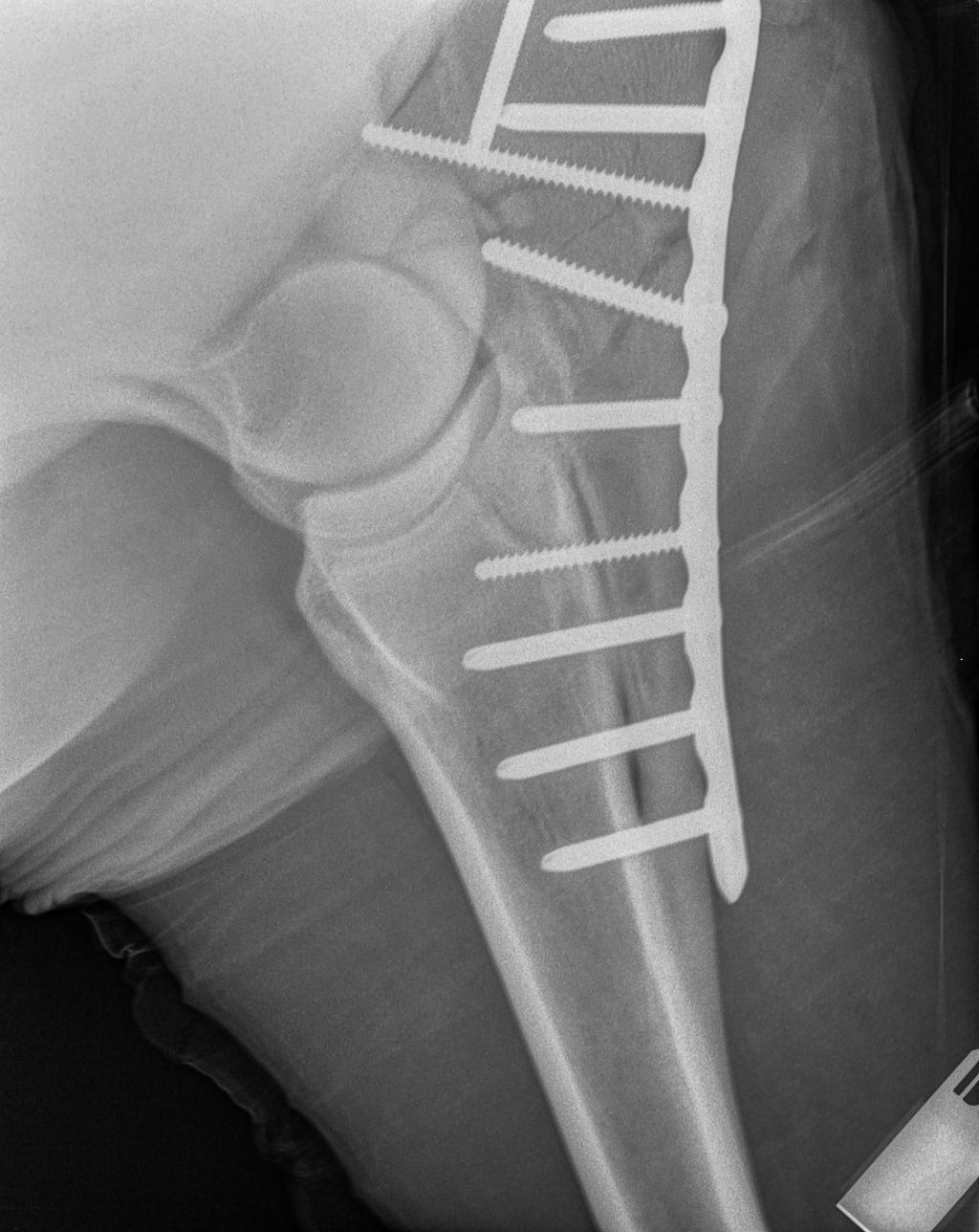 Drie weken later werden opnieuw radiografieën genomen en er waren geen afwijkingen ter hoogte van het