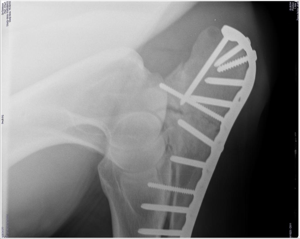 Fig. 7: Lateromediale opname van de elleboog, vier en halve maand postoperatief. Behalve in de zone naast het gewricht (pijl) zijn de fractuurlijnen sterk vervaagd door callusvorming.