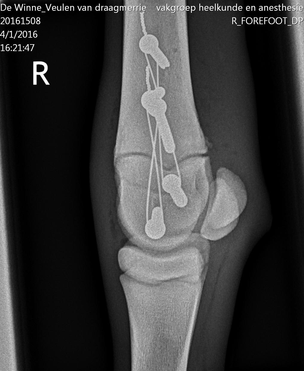 CS5: laterale 4,5 cortexschroef in de metafyse, proximaal van de fractuur (lengte 36 mm). Pijl: 1,2 mm cerclagedraad lateraal aangebracht volgens het tension band principe tussen CS4 en CS5.