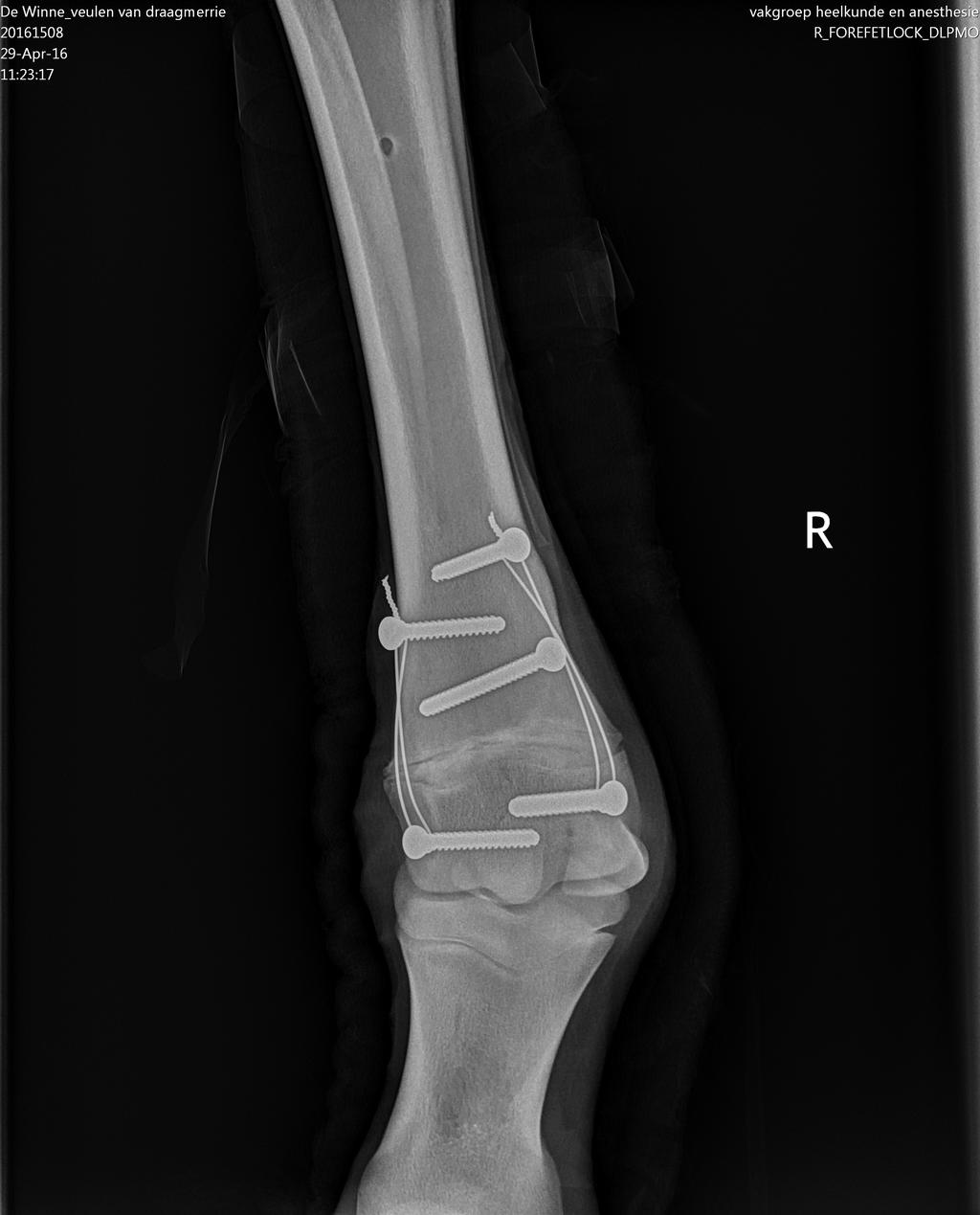 Het osteosynthese materiaal is intact.