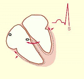 Het S-golf: ECG: eindfase